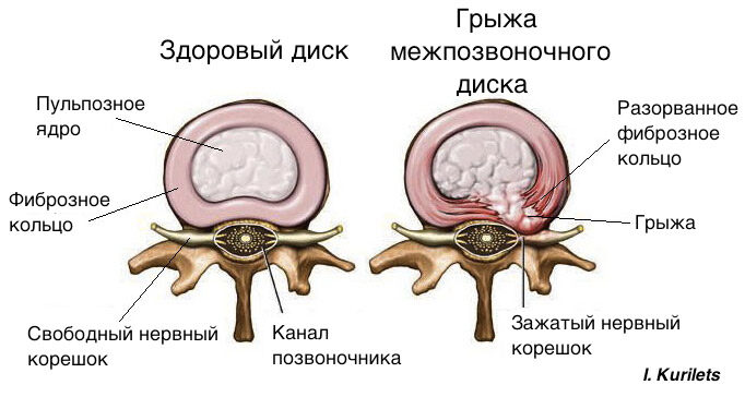 Беспокоит грыжа диска: вместо операции попробуй это!