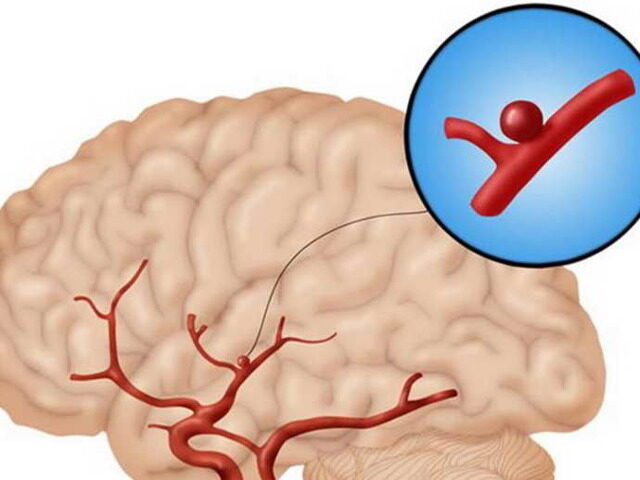 Сужение сосудов головного мозга, лечение и симптомы суженных сосудов головы
