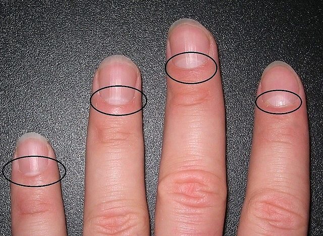 Вот почему могут исчезнуть белые лунки у основания ногтя: не пропусти тревожный симптом!