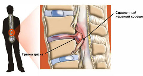 Беспокоит грыжа диска: вместо операции попробуй это!